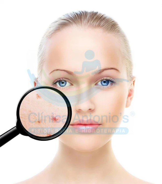 Acne: causas e tratamentos