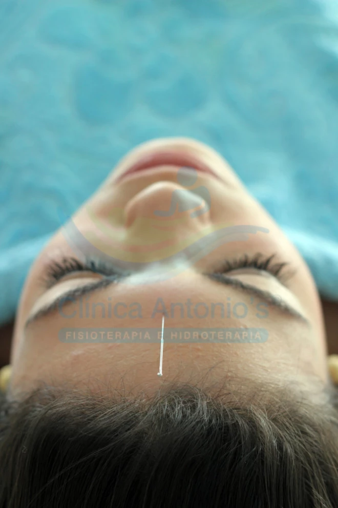 Acupuntura na Saúde da Mulher