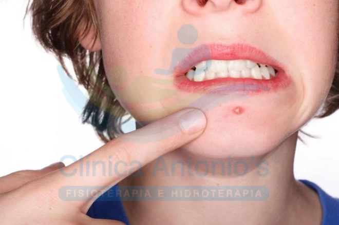 Adolescente pode fazer limpeza de pele?