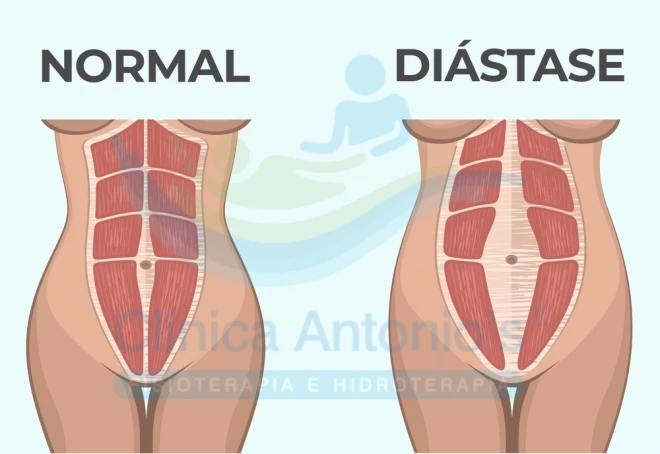 Diástese abdominal: o que é, como previnir e tratar
