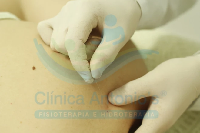 Dry needling precisa de encaminhamento médico?