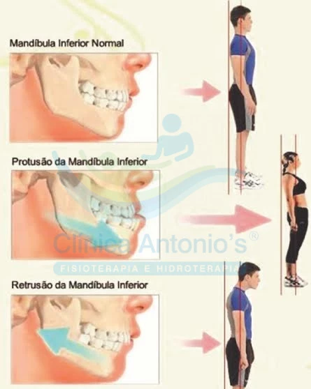 Fisioterapia ATM - Diferentes posições da mandíbula e alteração postural
