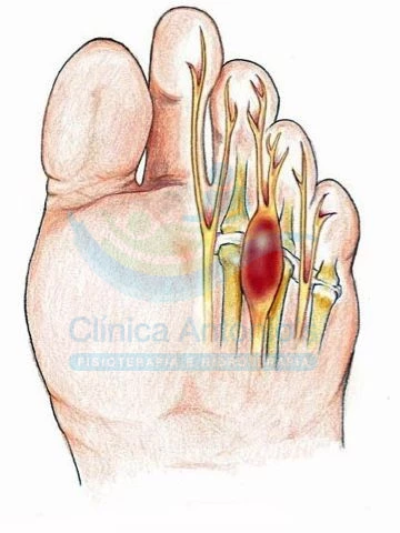 Neuroma de Morton, como tratar?