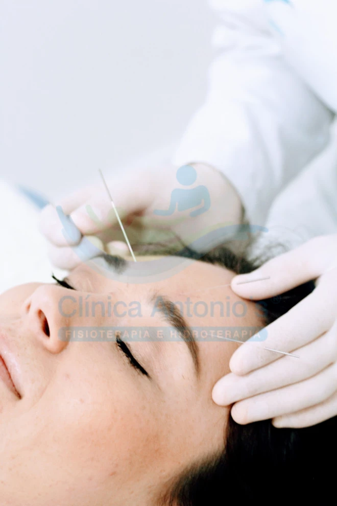 O DRY NEEDLING é uma terapia alternativa para tratar dores de cabeça e enxaqueca