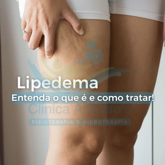 O que é Lipedema e como tratar?