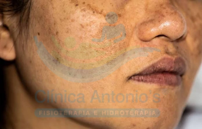 O que é melasma?