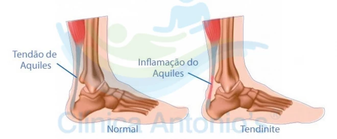 Tendinite no tendão de Aquiles, o que é e como tratar